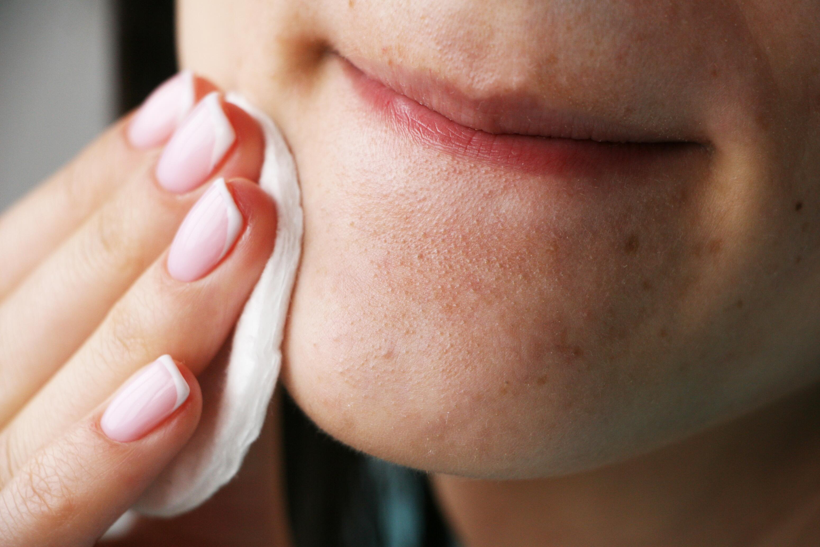 Retentionele acne met open mee-eters